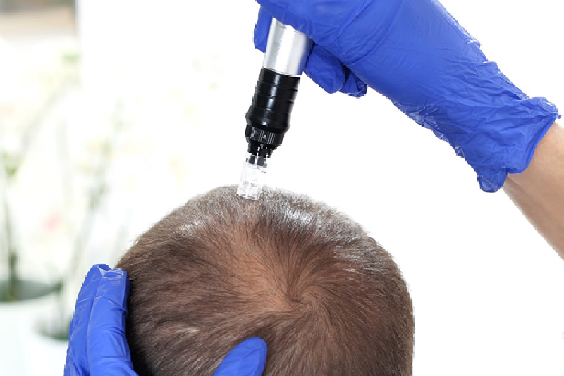 Microagulhamento Associado ao Minoxidil Tópico para Alopecia Androgenética